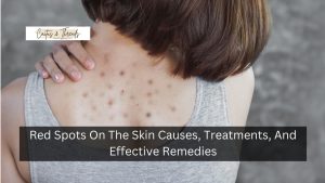 Red Spots On The Skin Causes, Treatments, And Effective Remedies