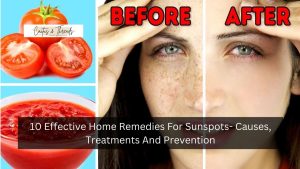 10 Effective Home Remedies For Sunspots- Causes, Treatments And Prevention