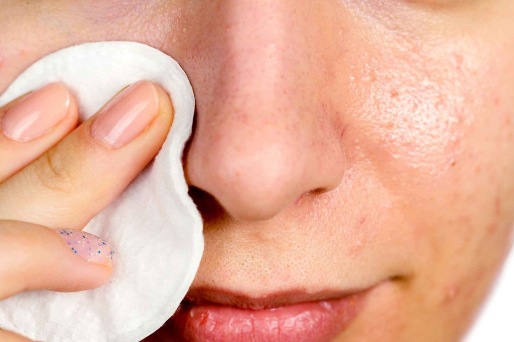 Effective Home Remedies To Remove Blackheads Naturally