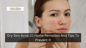 Dry Skin Acne 10 Home Remedies And Tips To Prevent It