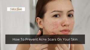 How To Prevent Acne Scars On Your Skin