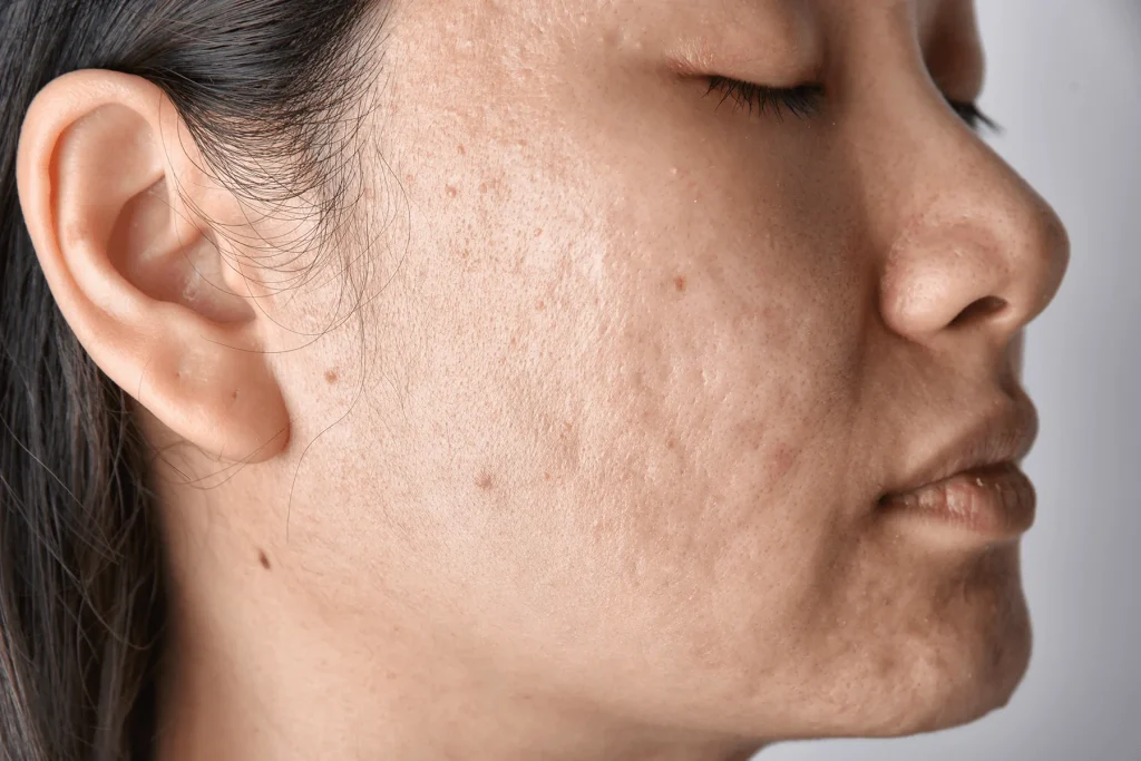 How To Prevent Acne Scars On Your Skin