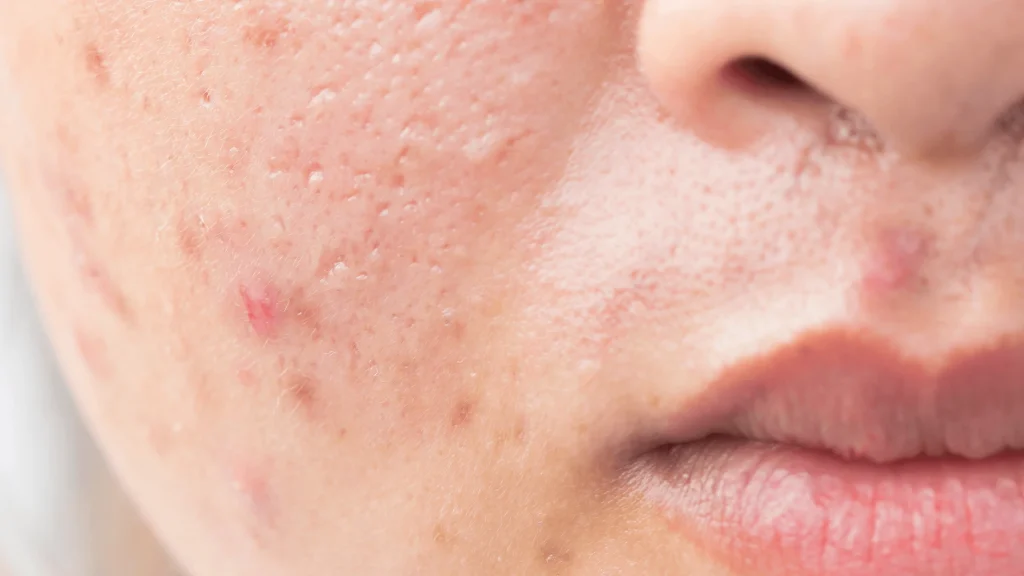 13 Effective Home Remedies And Diet Tips To Get Rid Of Pimples Fast