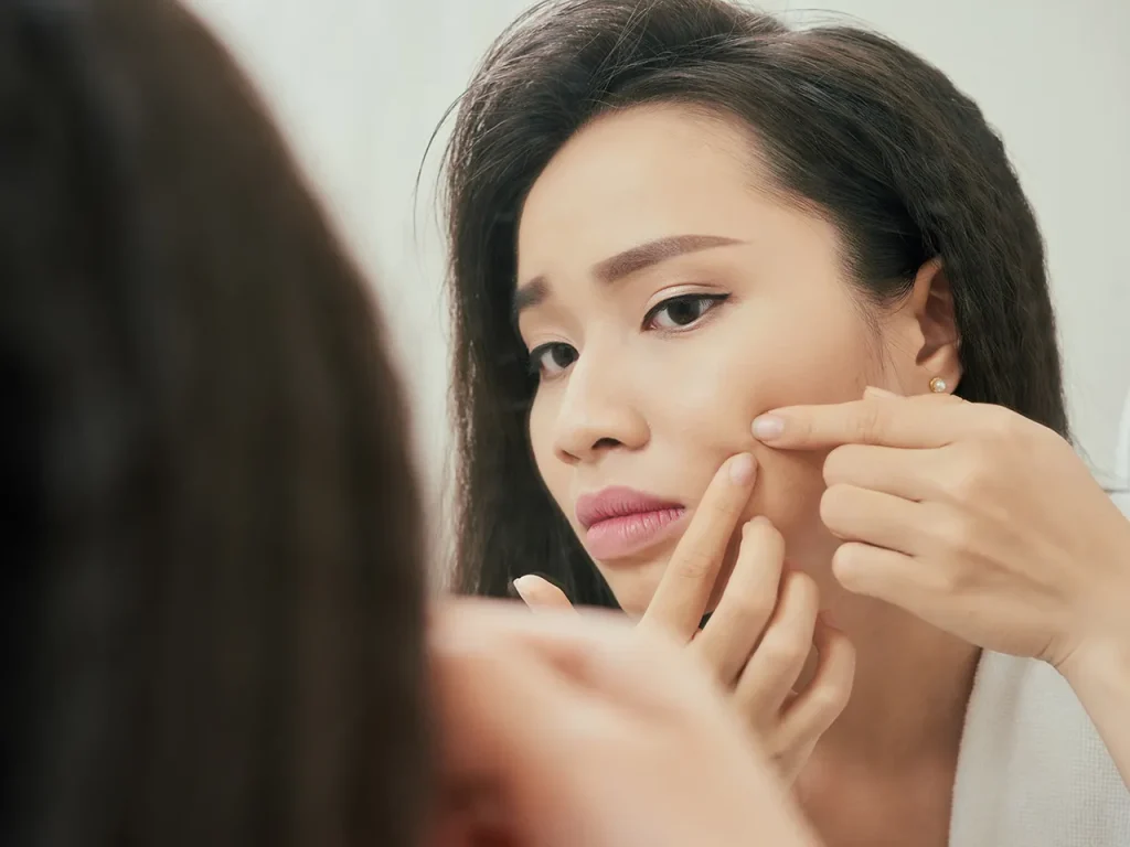 How To Prevent Acne Scars On Your Skin